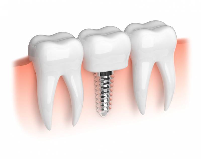 Implants dentaires sans douleur